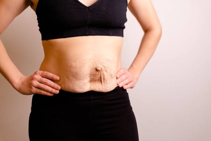 Is Surgery Really the Only Way to Repair Diastasis Recti Teddington?