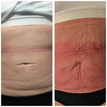 How Does RF Microneedling Improve Crepey, Thin and Uneven Skin Texture Teddington?