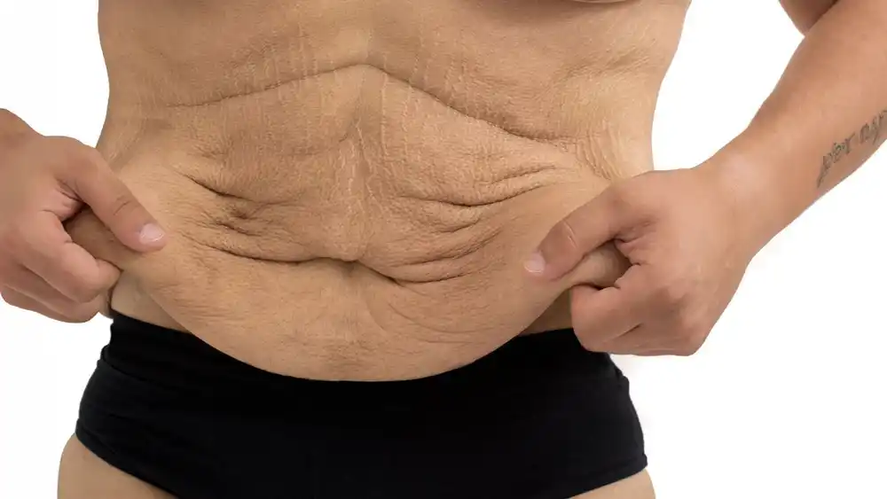 RF Microneedling for Loose Skin: How Can It Help Tighten and Reshape the Skin Teddington?